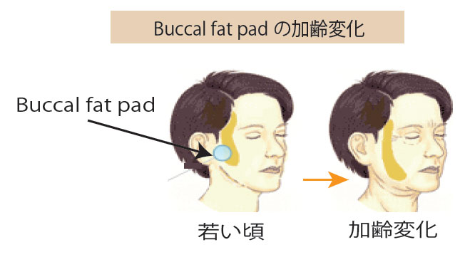 Buccal fat pad 切除術