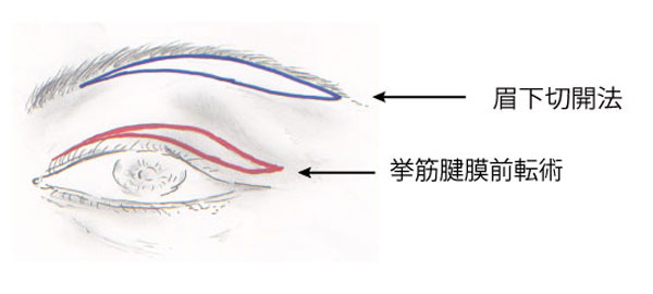 眉下切開法・挙筋腱膜前転術