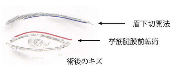 術後の傷